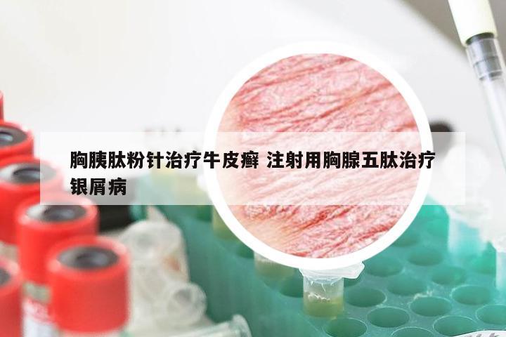 胸胰肽粉针治疗牛皮癣 注射用胸腺五肽治疗银屑病