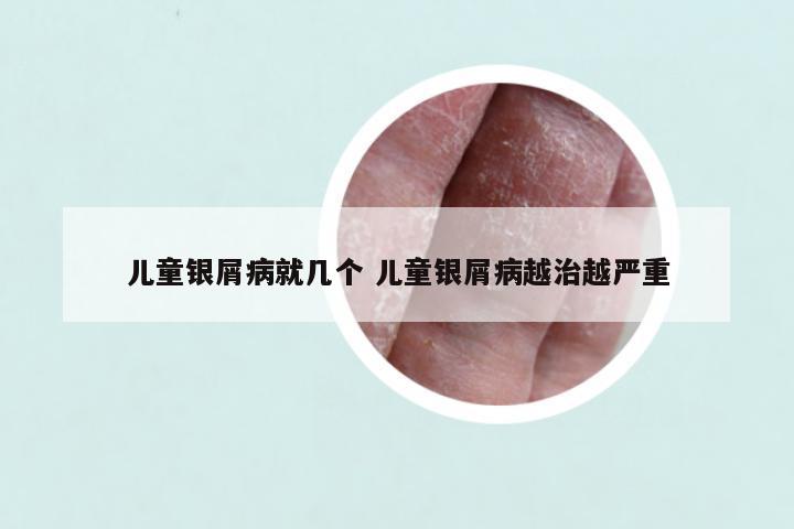 儿童银屑病就几个 儿童银屑病越治越严重