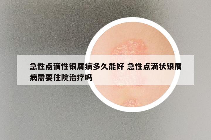 急性点滴性银屑病多久能好 急性点滴状银屑病需要住院治疗吗