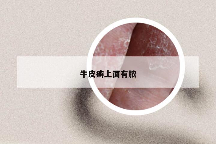牛皮癣上面有脓