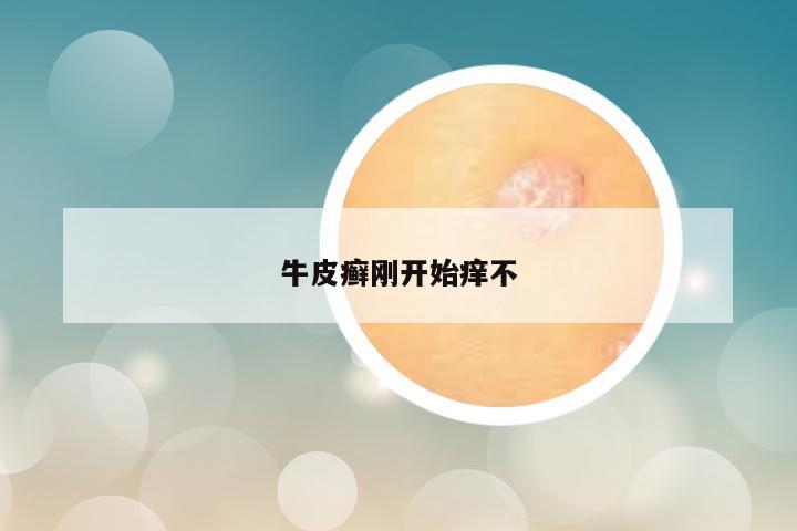 牛皮癣刚开始痒不