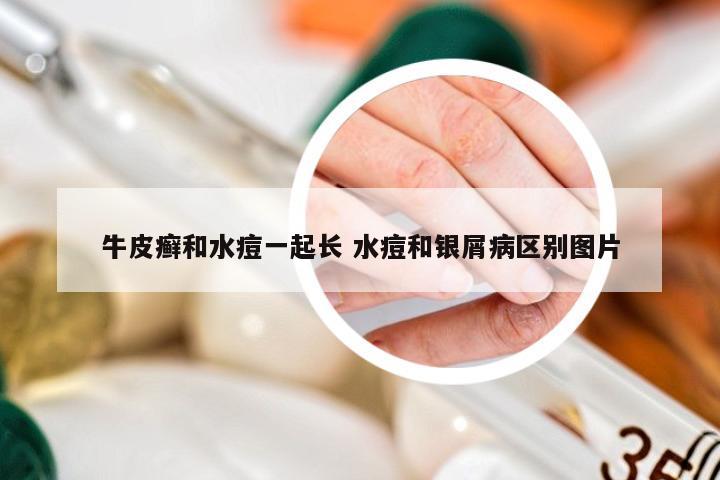 牛皮癣和水痘一起长 水痘和银屑病区别图片