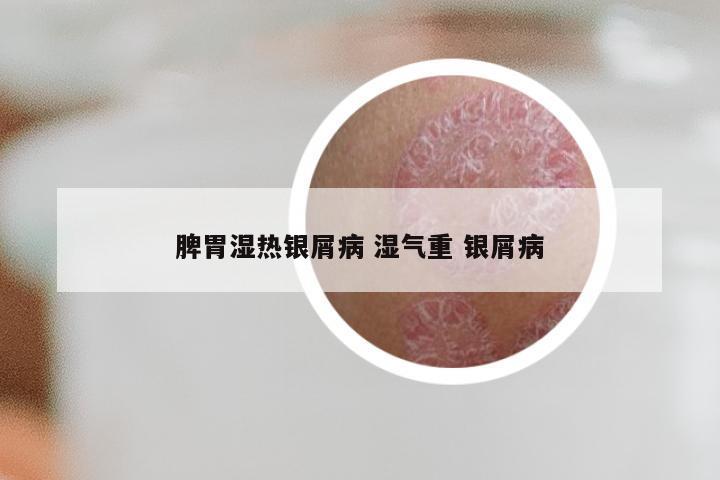 脾胃湿热银屑病 湿气重 银屑病