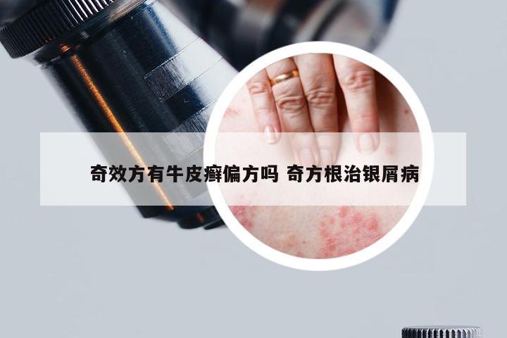 奇效方有牛皮癣偏方吗 奇方根治银屑病