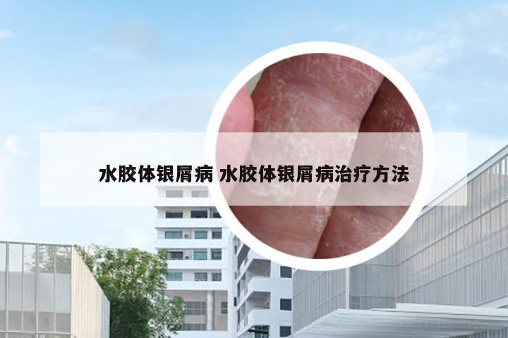 水胶体银屑病 水胶体银屑病治疗方法