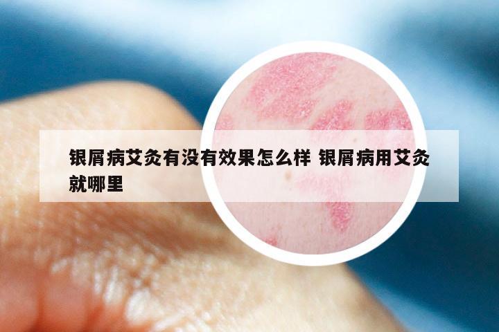 银屑病艾灸有没有效果怎么样 银屑病用艾灸就哪里