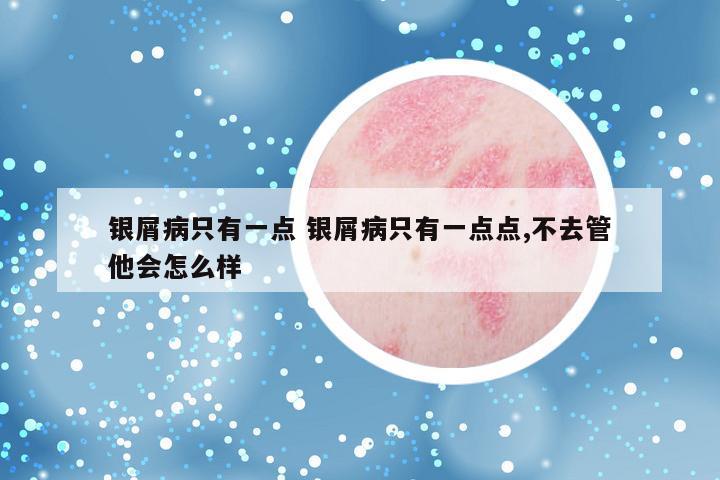 银屑病只有一点 银屑病只有一点点,不去管他会怎么样