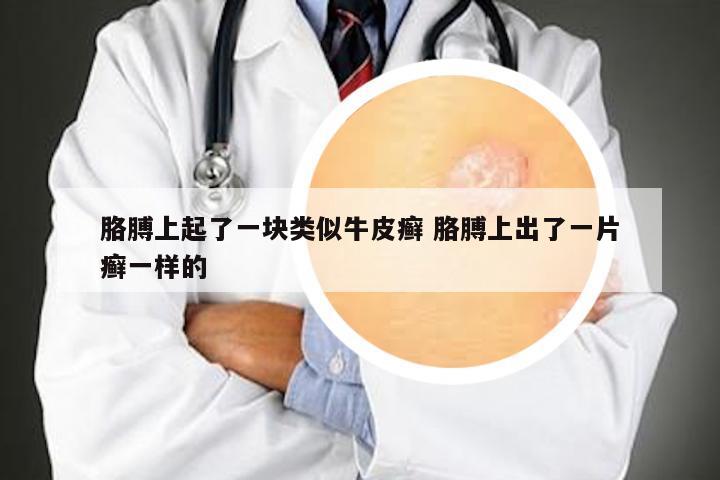 胳膊上起了一块类似牛皮癣 胳膊上出了一片癣一样的