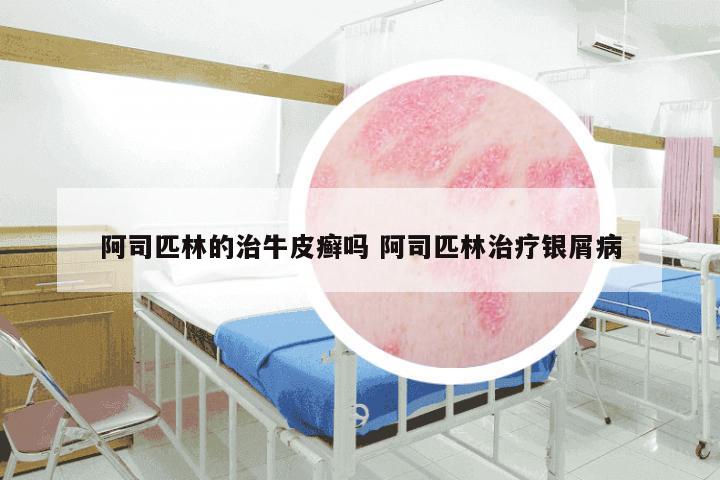 阿司匹林的治牛皮癣吗 阿司匹林治疗银屑病