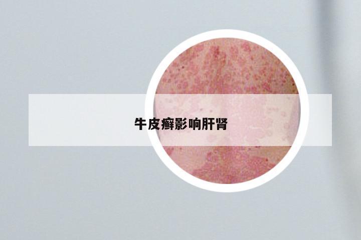 牛皮癣影响肝肾