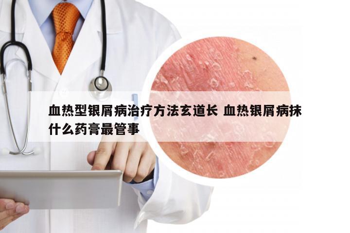 血热型银屑病治疗方法玄道长 血热银屑病抹什么药膏最管事