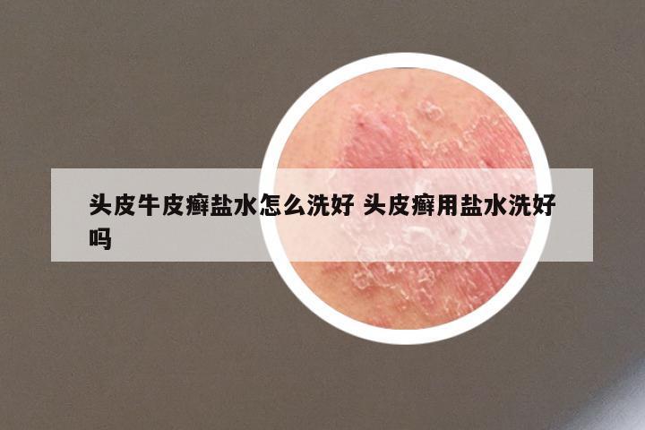 头皮牛皮癣盐水怎么洗好 头皮癣用盐水洗好吗