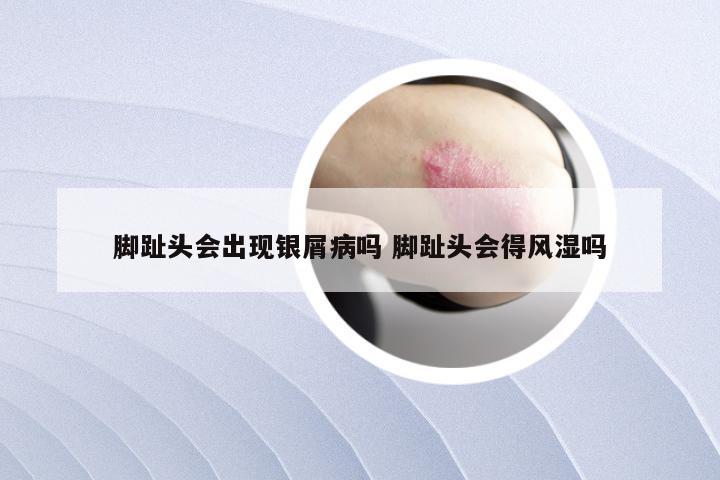 脚趾头会出现银屑病吗 脚趾头会得风湿吗