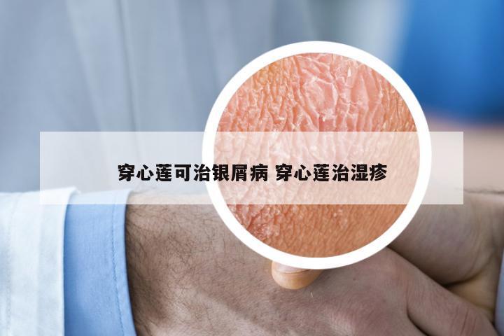 穿心莲可治银屑病 穿心莲治湿疹