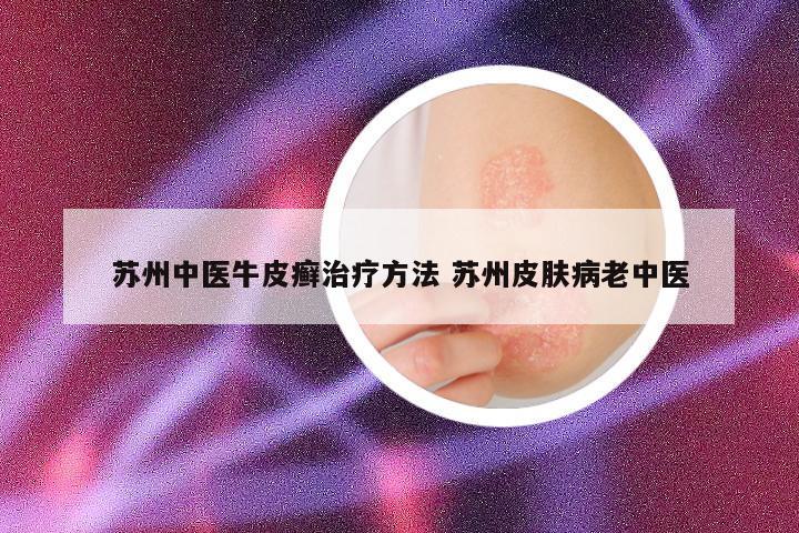 苏州中医牛皮癣治疗方法 苏州皮肤病老中医