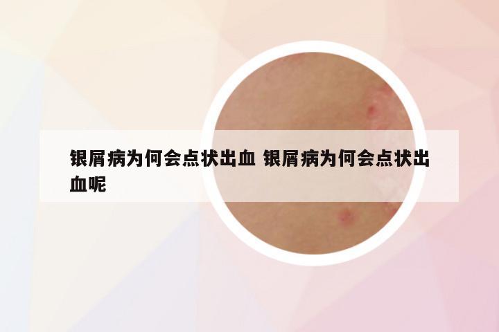 银屑病为何会点状出血 银屑病为何会点状出血呢