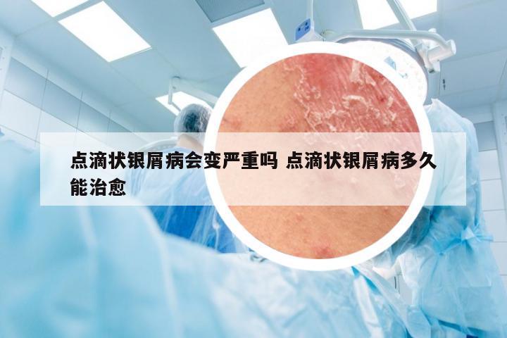 点滴状银屑病会变严重吗 点滴状银屑病多久能治愈