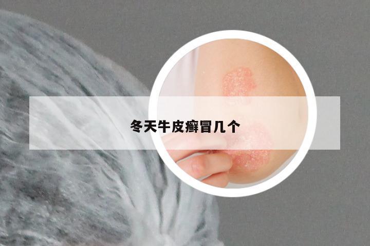冬天牛皮癣冒几个