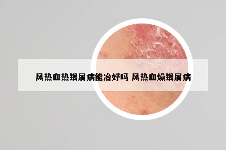 风热血热银屑病能冶好吗 风热血燥银屑病