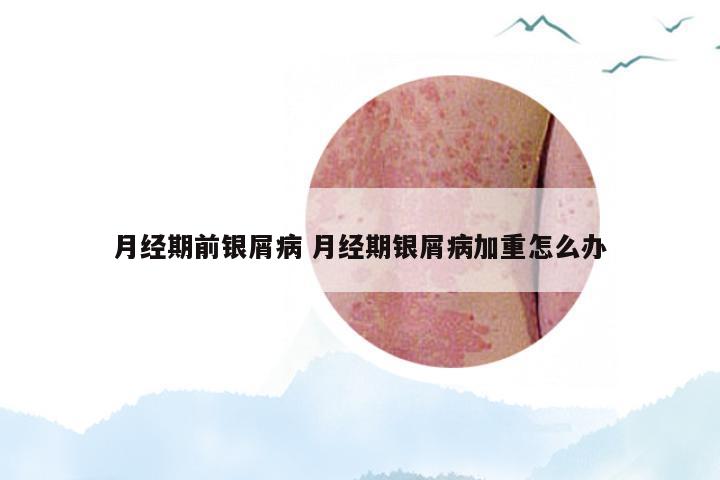 月经期前银屑病 月经期银屑病加重怎么办