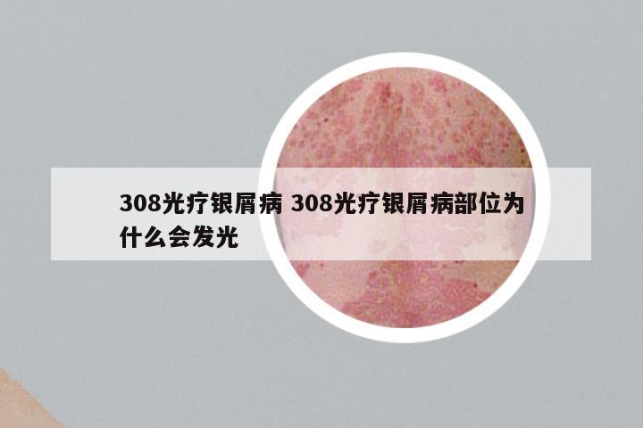 308光疗银屑病 308光疗银屑病部位为什么会发光