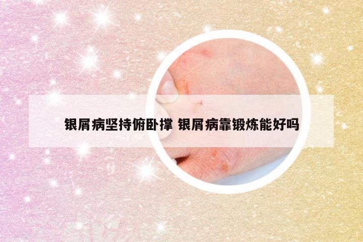 银屑病坚持俯卧撑 银屑病靠锻炼能好吗