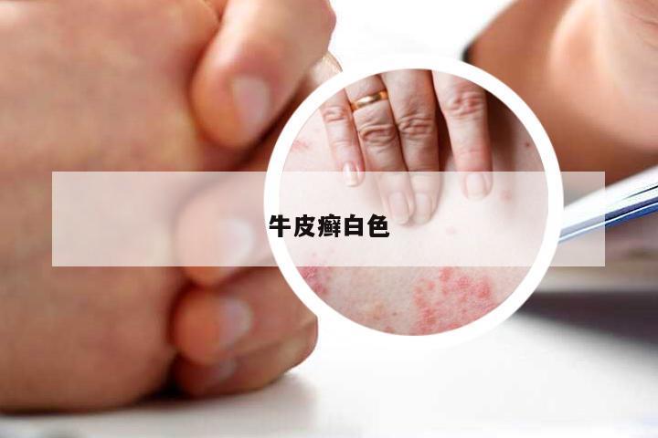 牛皮癣白色