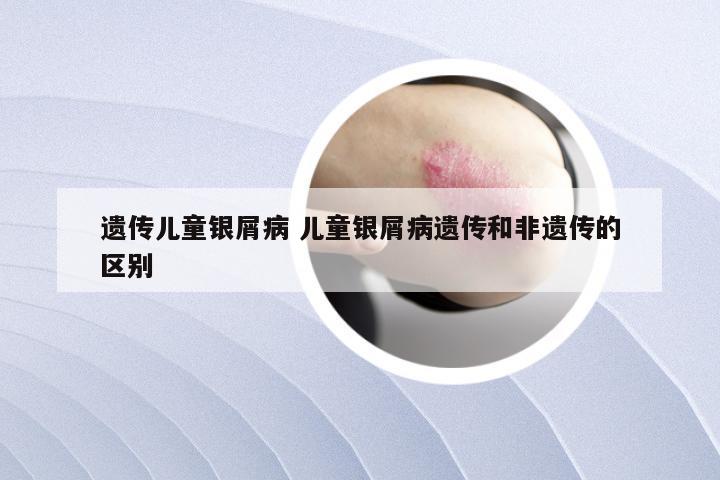 遗传儿童银屑病 儿童银屑病遗传和非遗传的区别
