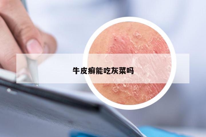 牛皮癣能吃灰菜吗