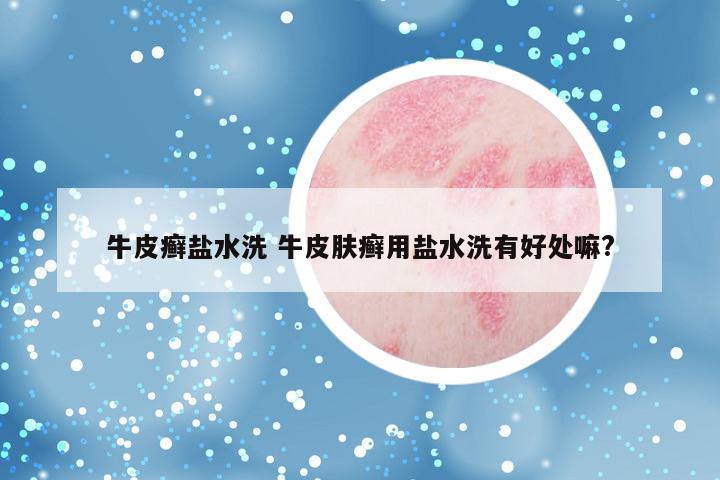牛皮癣盐水洗 牛皮肤癣用盐水洗有好处嘛?