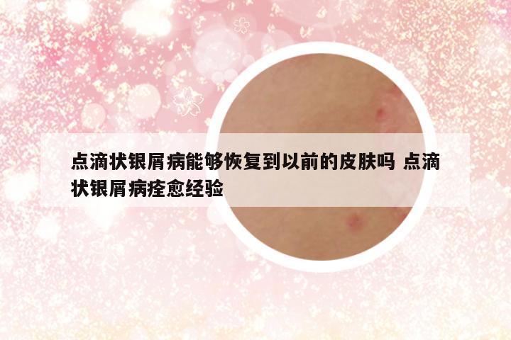 点滴状银屑病能够恢复到以前的皮肤吗 点滴状银屑病痊愈经验