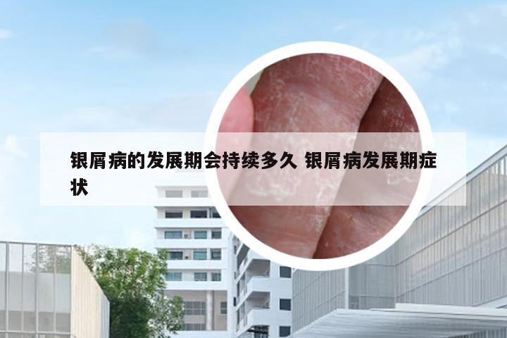 银屑病的发展期会持续多久 银屑病发展期症状