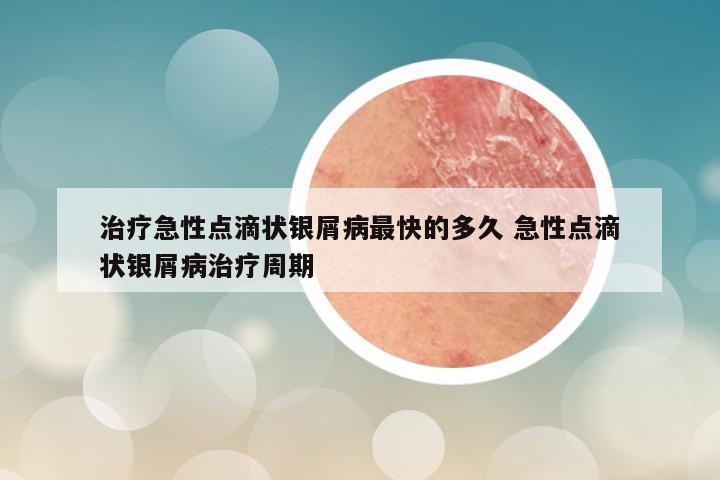 治疗急性点滴状银屑病最快的多久 急性点滴状银屑病治疗周期