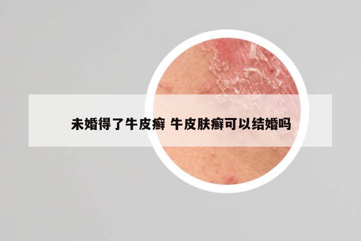 未婚得了牛皮癣 牛皮肤癣可以结婚吗