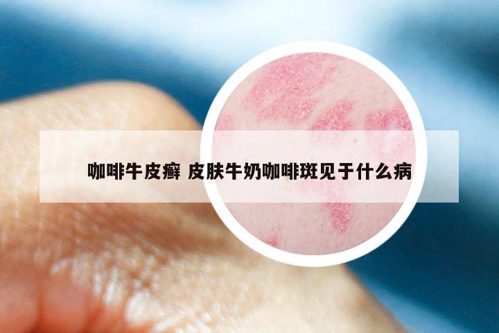 咖啡牛皮癣 皮肤牛奶咖啡斑见于什么病