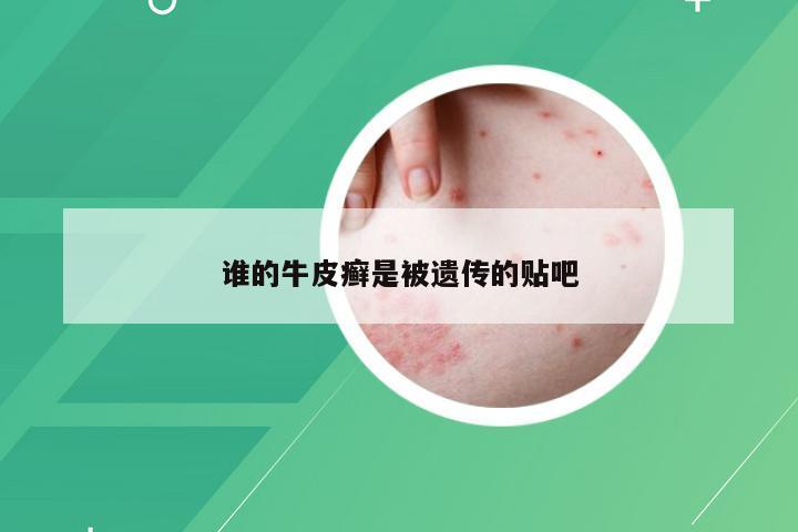 谁的牛皮癣是被遗传的贴吧