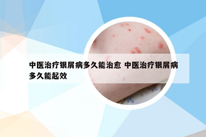 中医治疗银屑病多久能治愈 中医治疗银屑病多久能起效