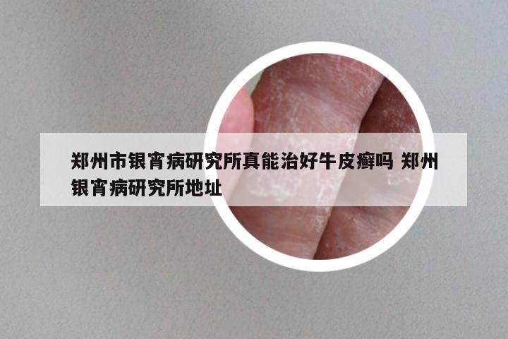 郑州市银宵病研究所真能治好牛皮癣吗 郑州银宵病研究所地址