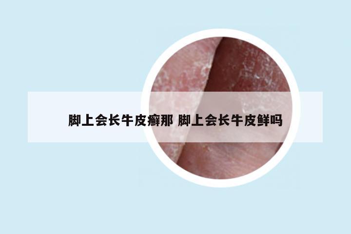 脚上会长牛皮癣那 脚上会长牛皮鲜吗
