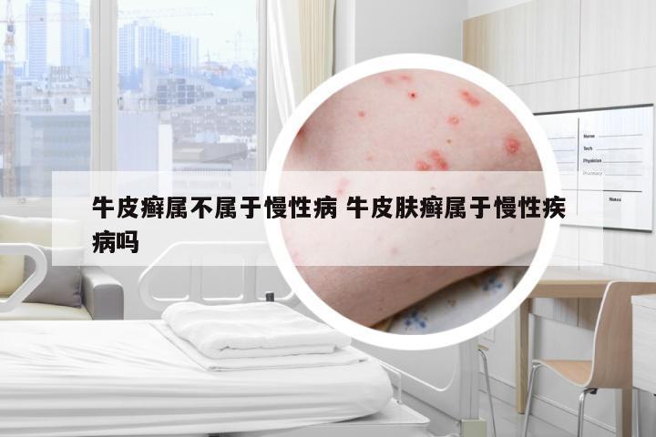 牛皮癣属不属于慢性病 牛皮肤癣属于慢性疾病吗