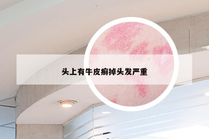 头上有牛皮癣掉头发严重