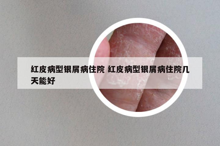 红皮病型银屑病住院 红皮病型银屑病住院几天能好