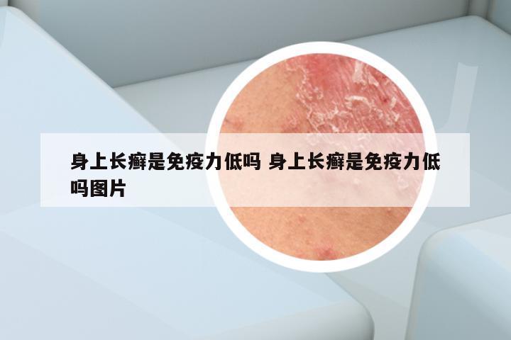 身上长癣是免疫力低吗 身上长癣是免疫力低吗图片