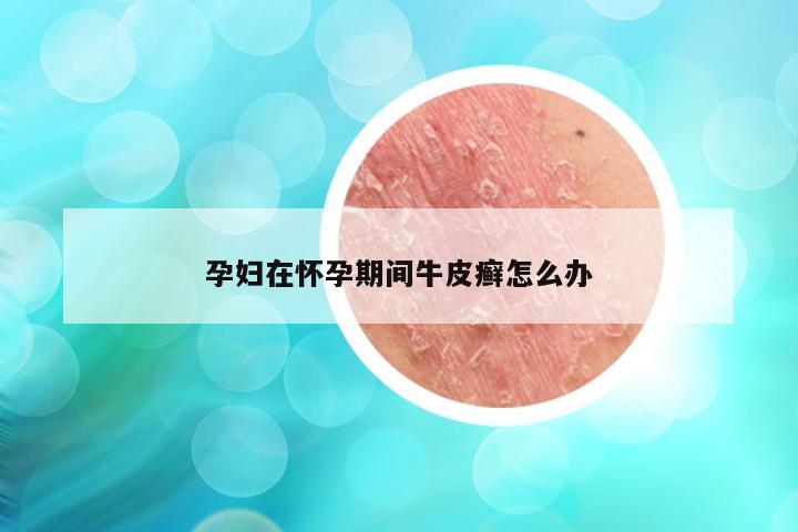 孕妇在怀孕期间牛皮癣怎么办