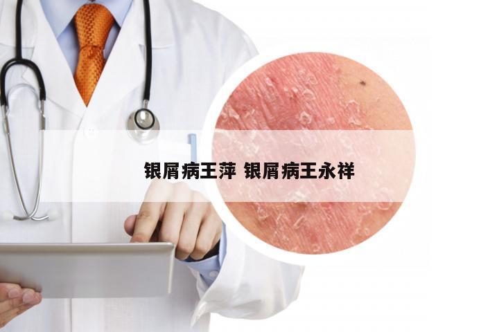 银屑病王萍 银屑病王永祥