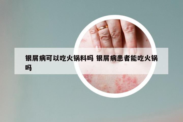 银屑病可以吃火锅料吗 银屑病患者能吃火锅吗