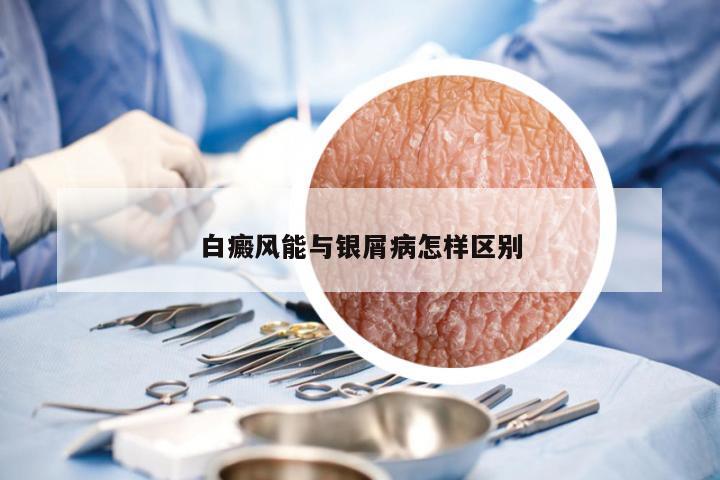 白癜风能与银屑病怎样区别