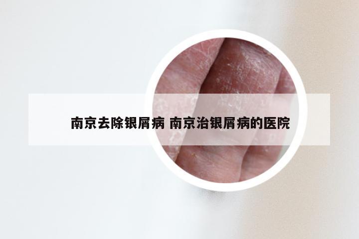 南京去除银屑病 南京治银屑病的医院