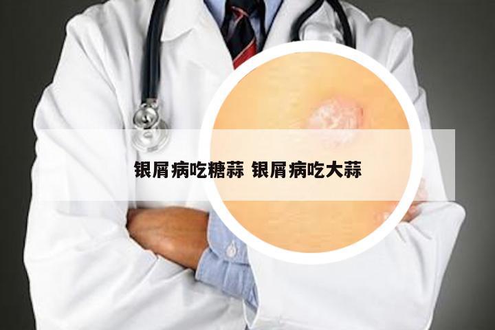 银屑病吃糖蒜 银屑病吃大蒜