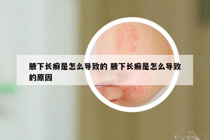 腋下长癣是怎么导致的 腋下长癣是怎么导致的原因